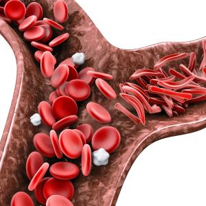 Voxelotor improves Hb levels, haemolysis markers in younger children with SCD