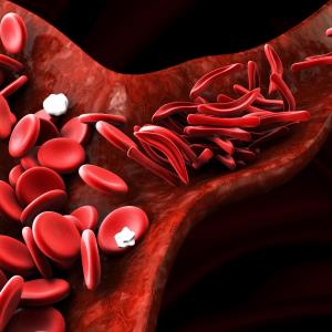 Overall outlook for paediatric sickle cell disease improved with stem cell transplant