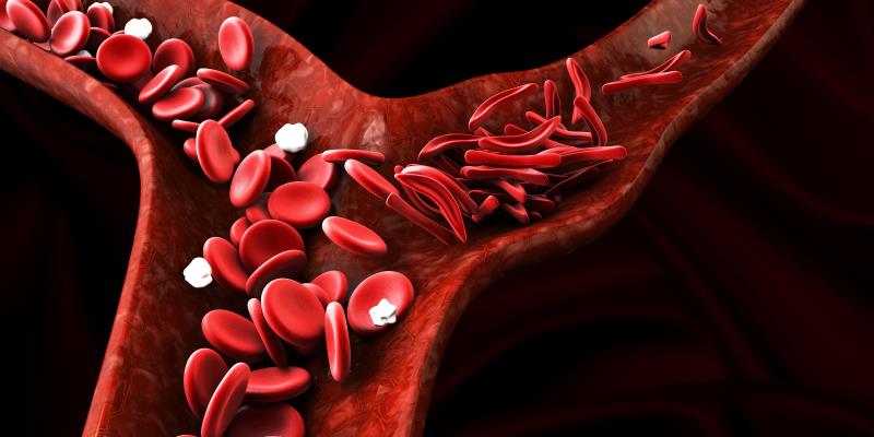 Overall outlook for paediatric sickle cell disease improved with stem cell transplant