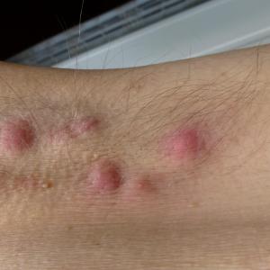 Brodalumab safe, effective in hidradenitis suppurativa