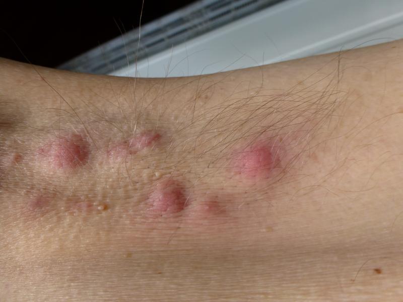 Inflammatory markers, leukocyte show promise in evaluating hidradenitis suppurativa severity