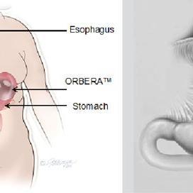 Depression, anxiety tied to intragastric balloon intolerance, early removal