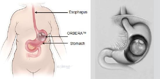 Weight loss balloon placement: A deflated intragastric balloon is inserted into the patient’s stomach, and removed after six 