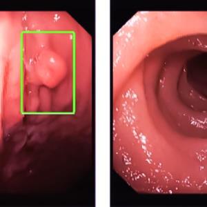 Which imaging mode is more effective in detecting gastric neoplasms?
