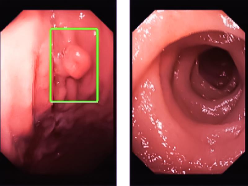 Which imaging mode is more effective in detecting gastric neoplasms?
