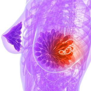 70-gene signature identifies ultra-low risk of distant recurrence in breast cancer patients