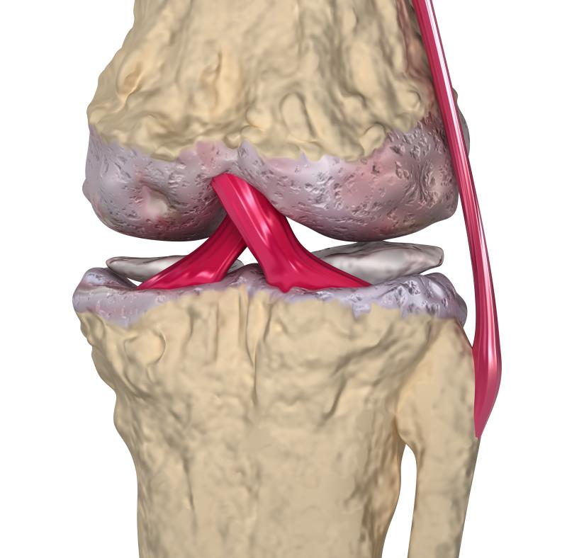 Zoledronic acid fails to ZAP pain, structural progression in knee OA