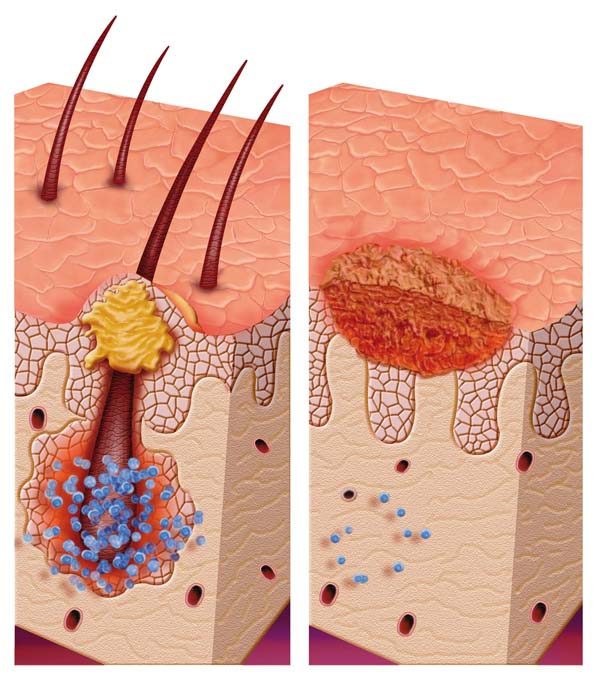 Cellulitis/Erysipelas