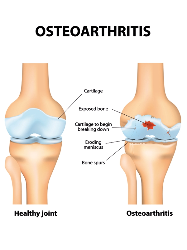 Osteoarthritis