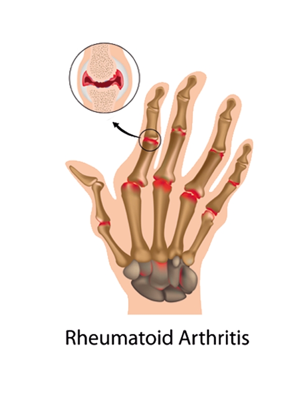 Rheumatoid Arthritis