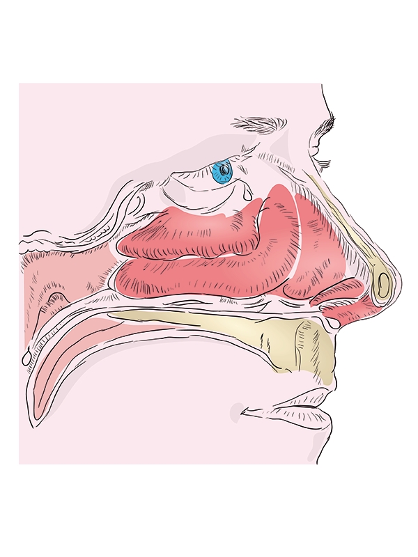 Rhinitis - Nonallergic