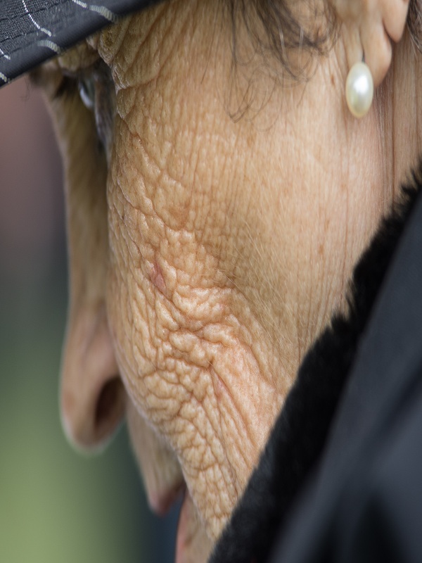Rhytides (Wrinkles)