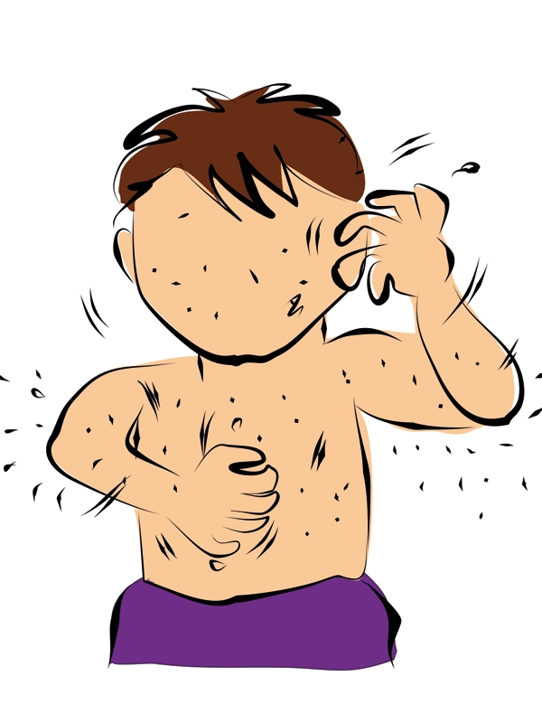 Scabies