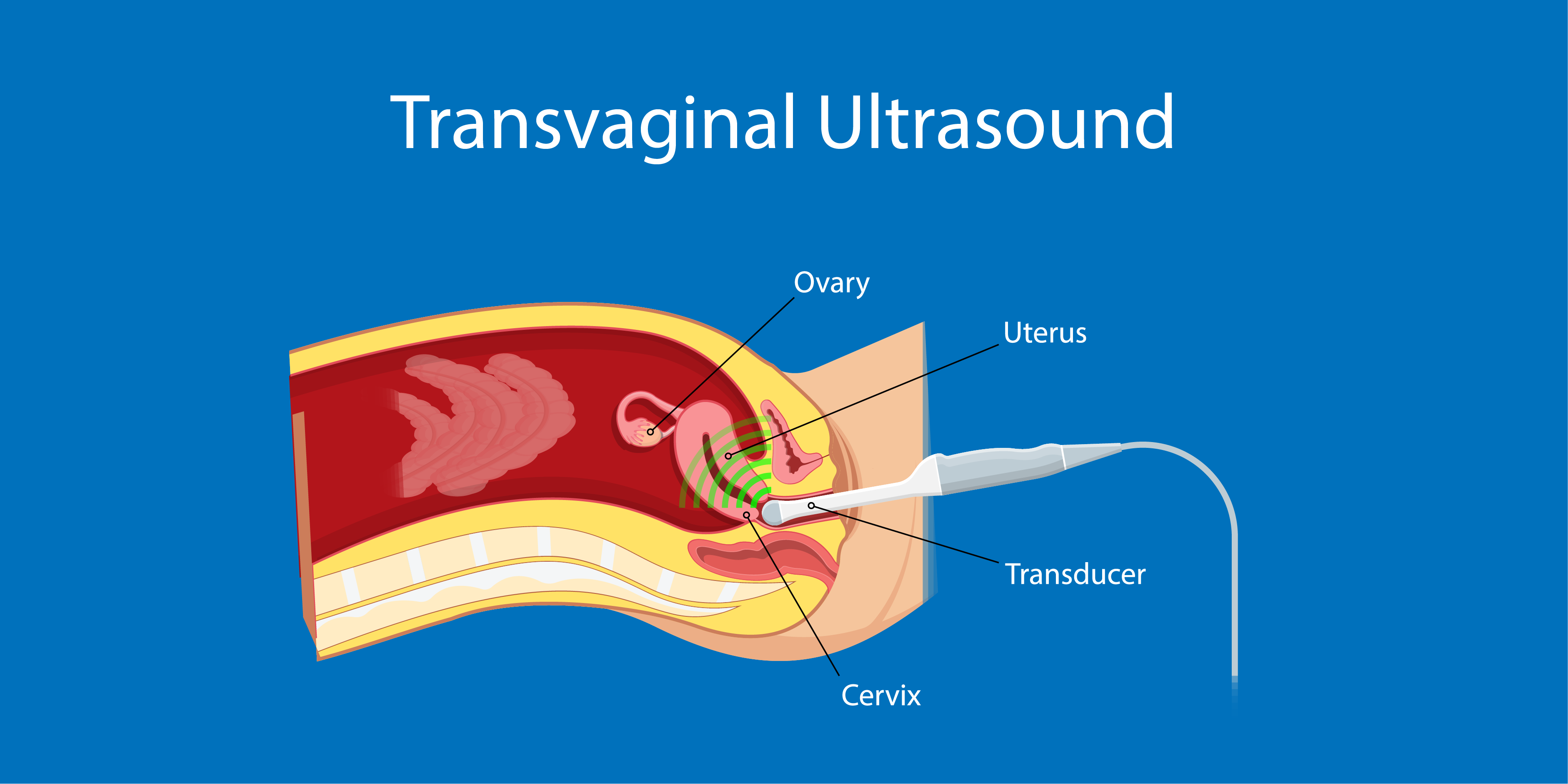 Ovarian Cancer_Diagnostics