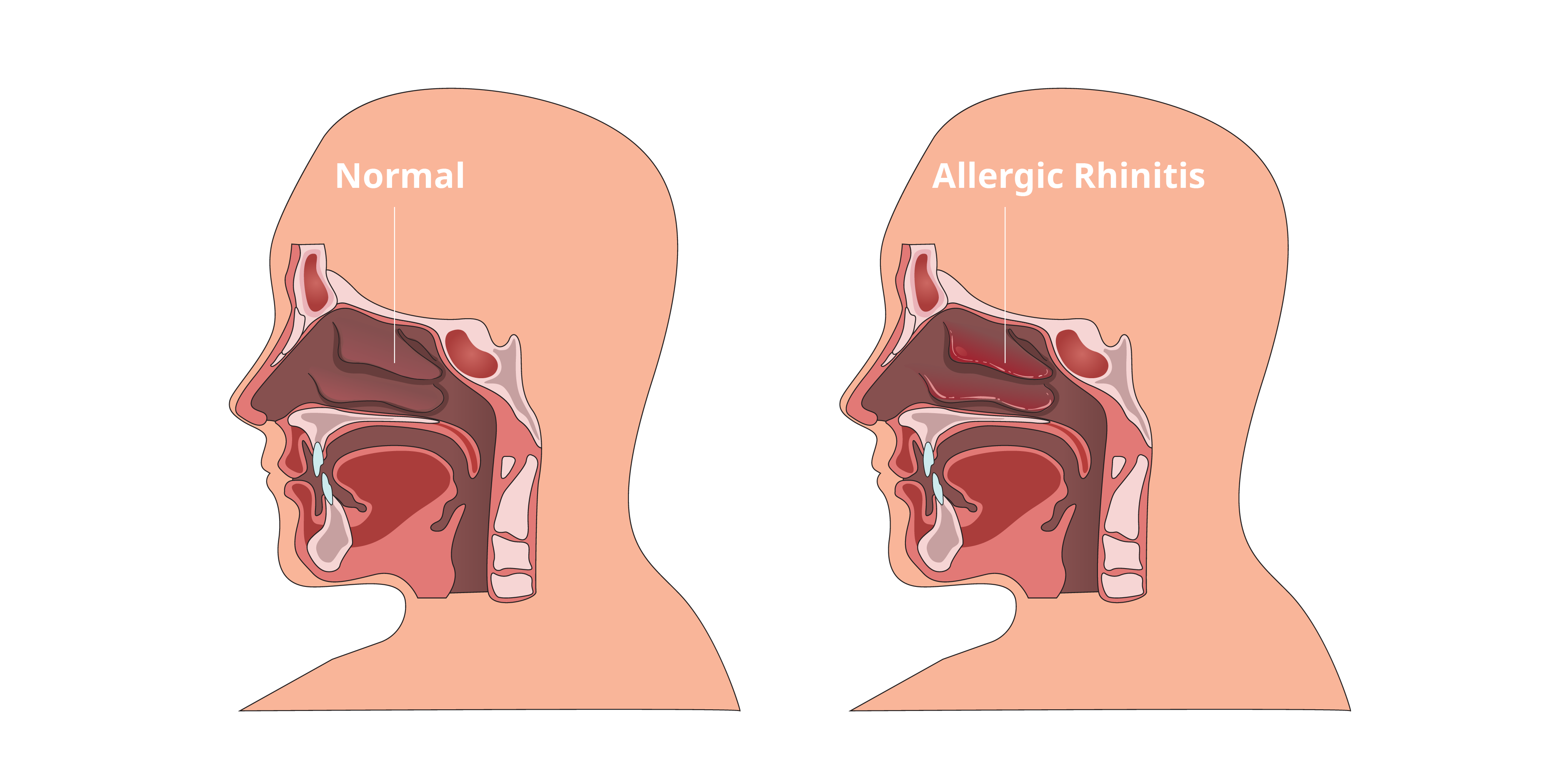 Rhinitis - Allergic (Initial Assessment 2)