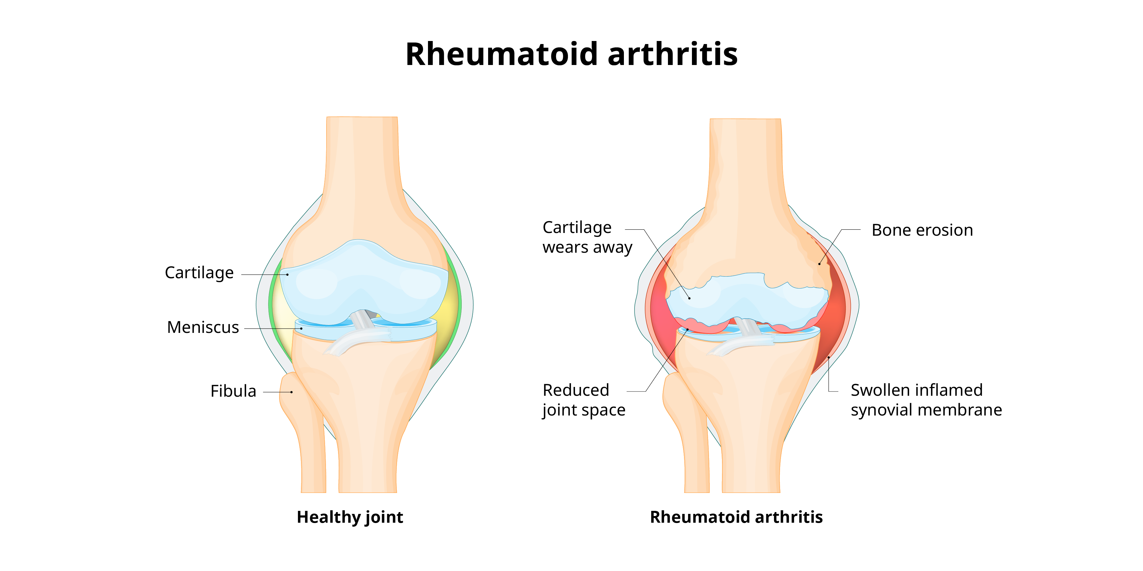 Rheumatoid arthritis - pathophysiology