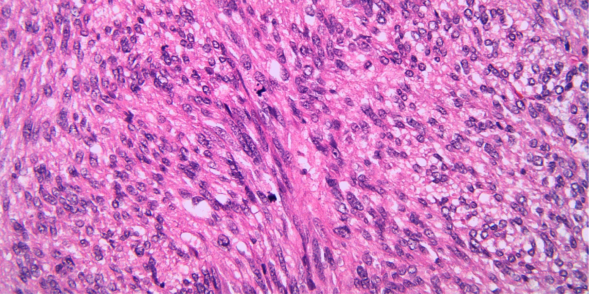 Gastrointestinal Stromal Tumor_Diagnostics