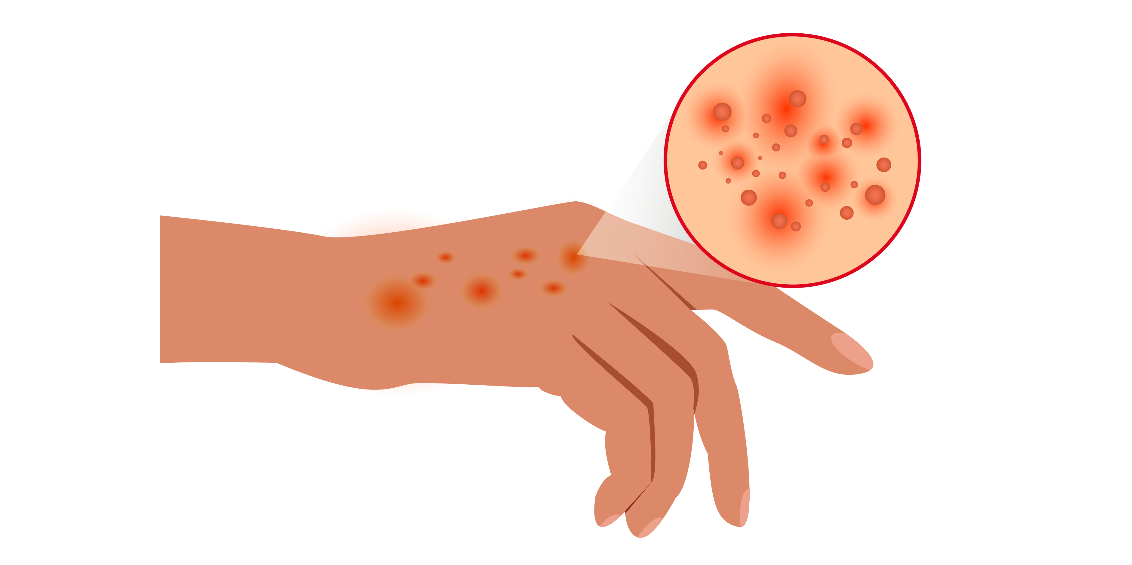 Atopic Dermatitis : Disease Summary | MIMS Singapore