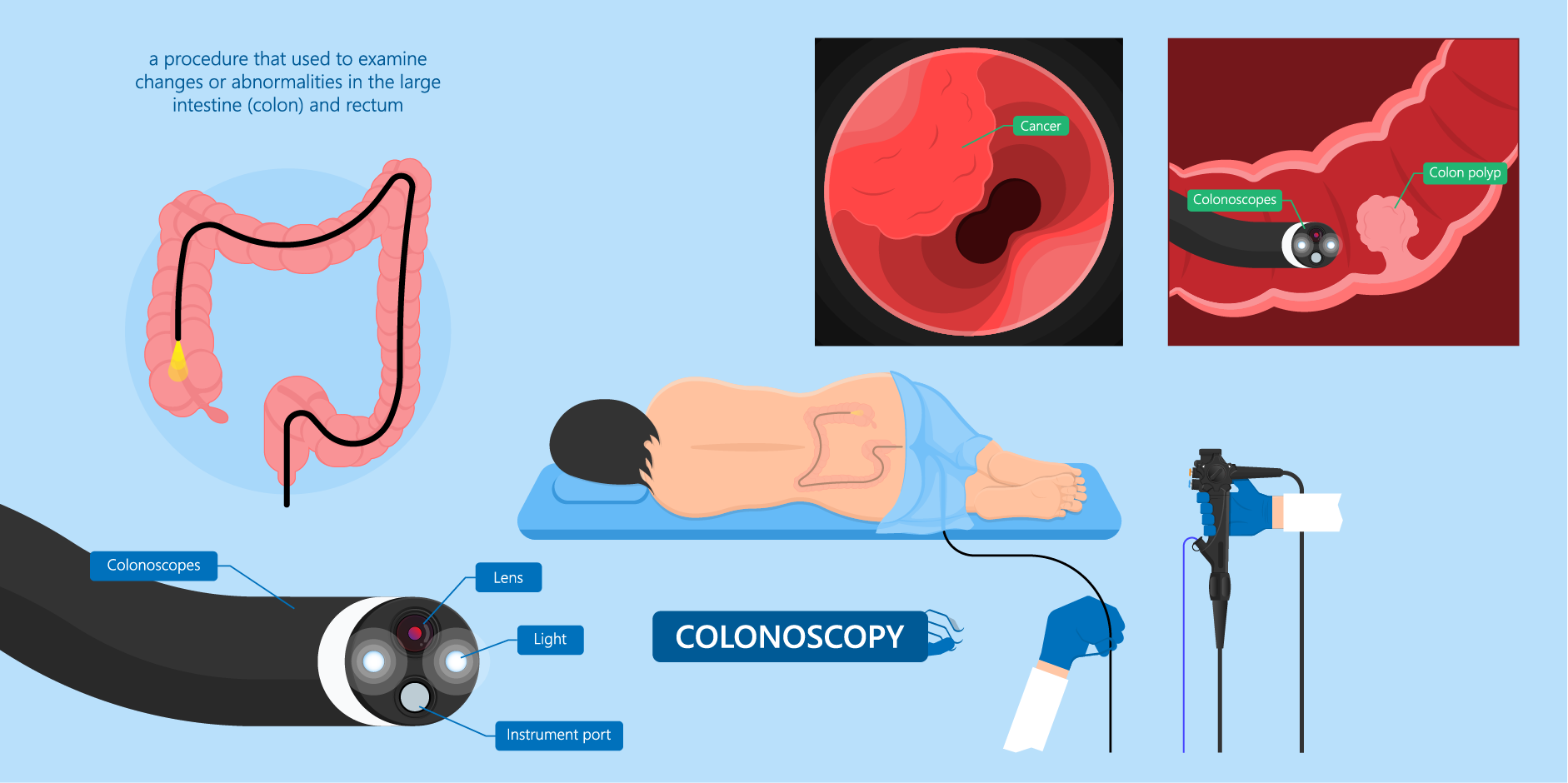 Colorectal Cancer_Diagnostic