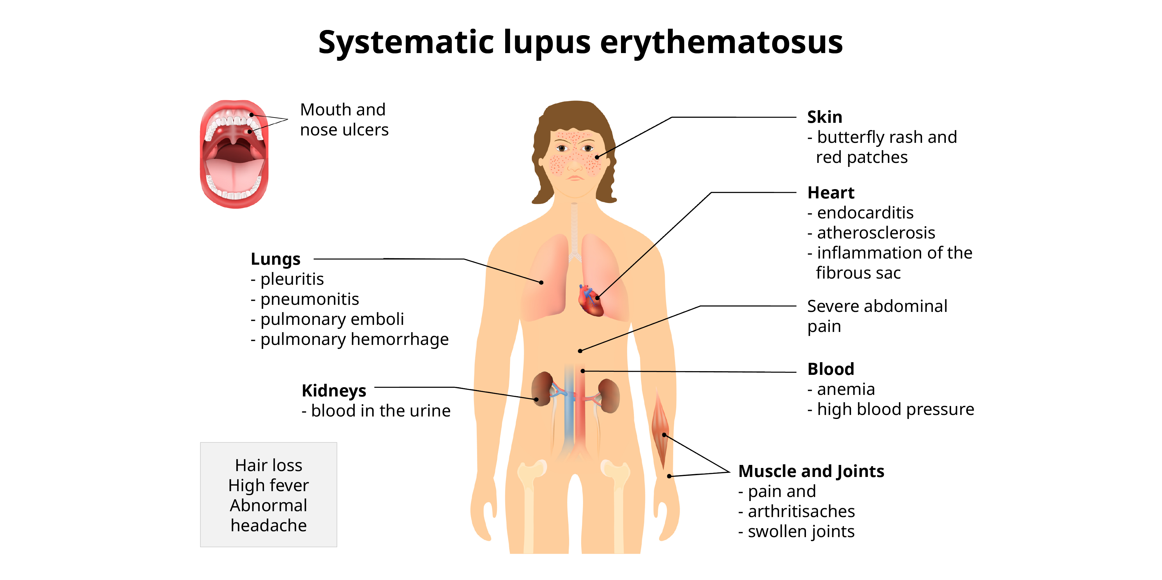 Systemic Lupus Erythematosus_Background