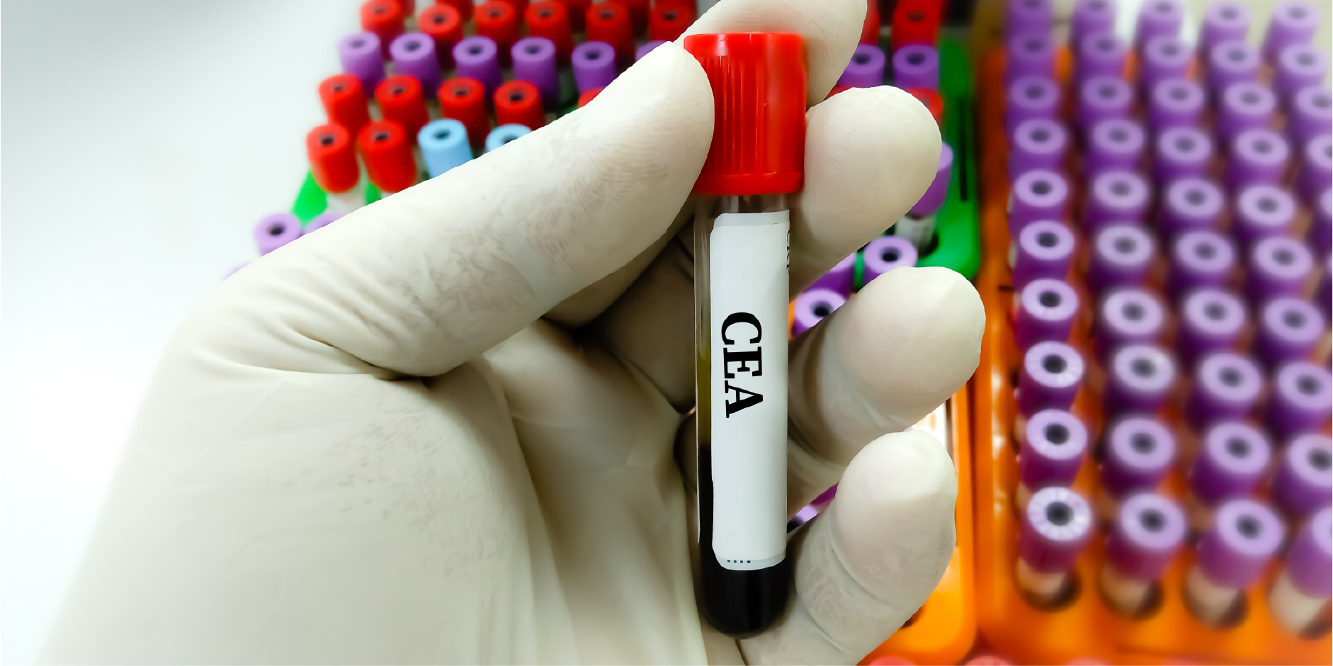 Colorectal Cancer_Diagnostic 2