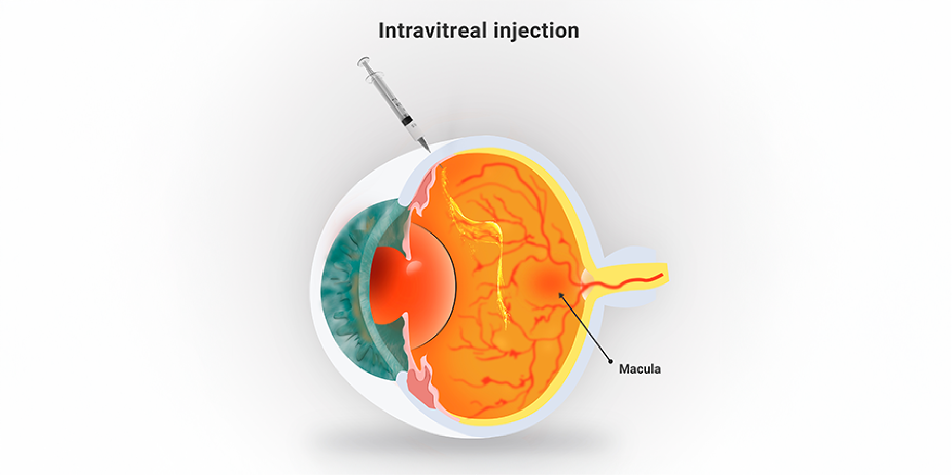 Age-Related Macular Degeneration_Management 1