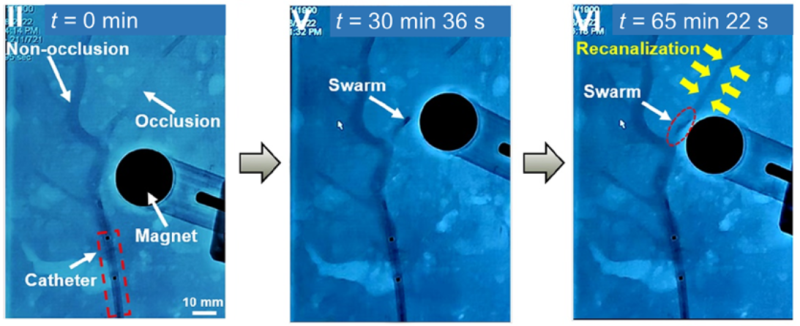 Ex vivo thrombolysis with tPA-nbot microswarm in human placenta model under catheter-assisted magnetic
actuation system. Adapted from Sci Adv 2024;10:eadk8970.