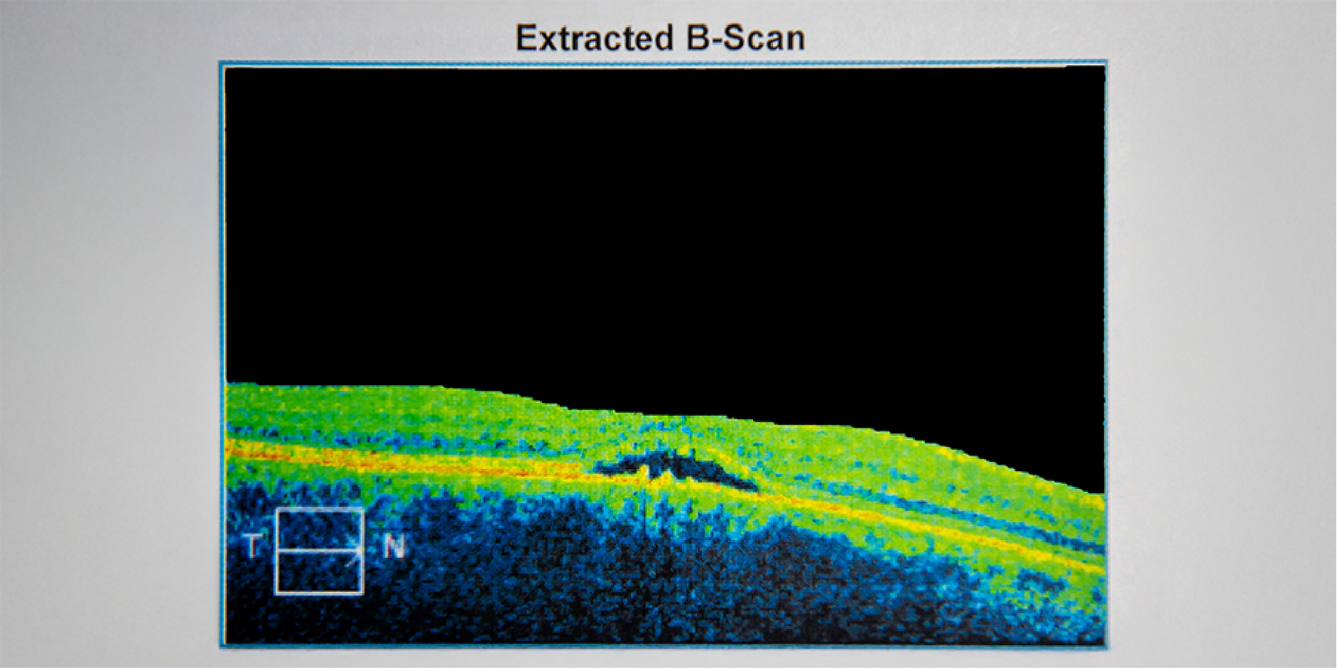 Age-Related Macular Degeneration_Diagnostics