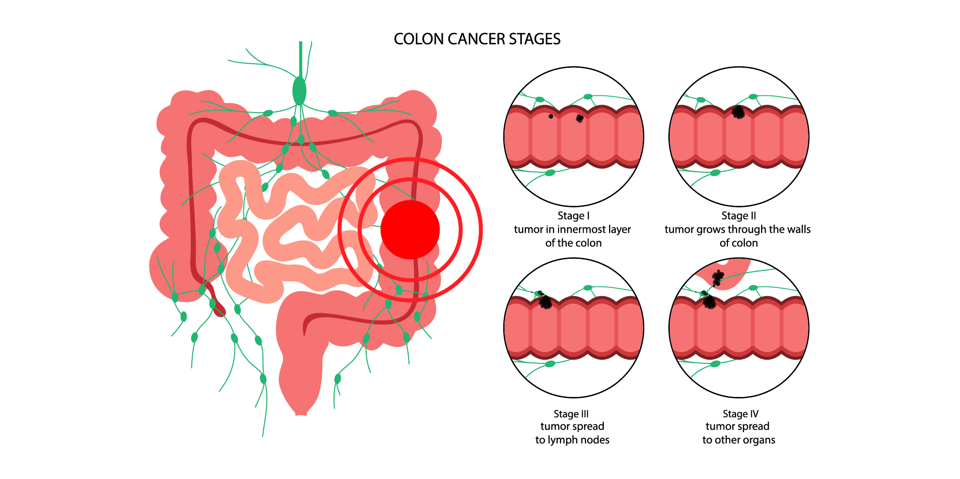 Colorectal Cancer_Management 2