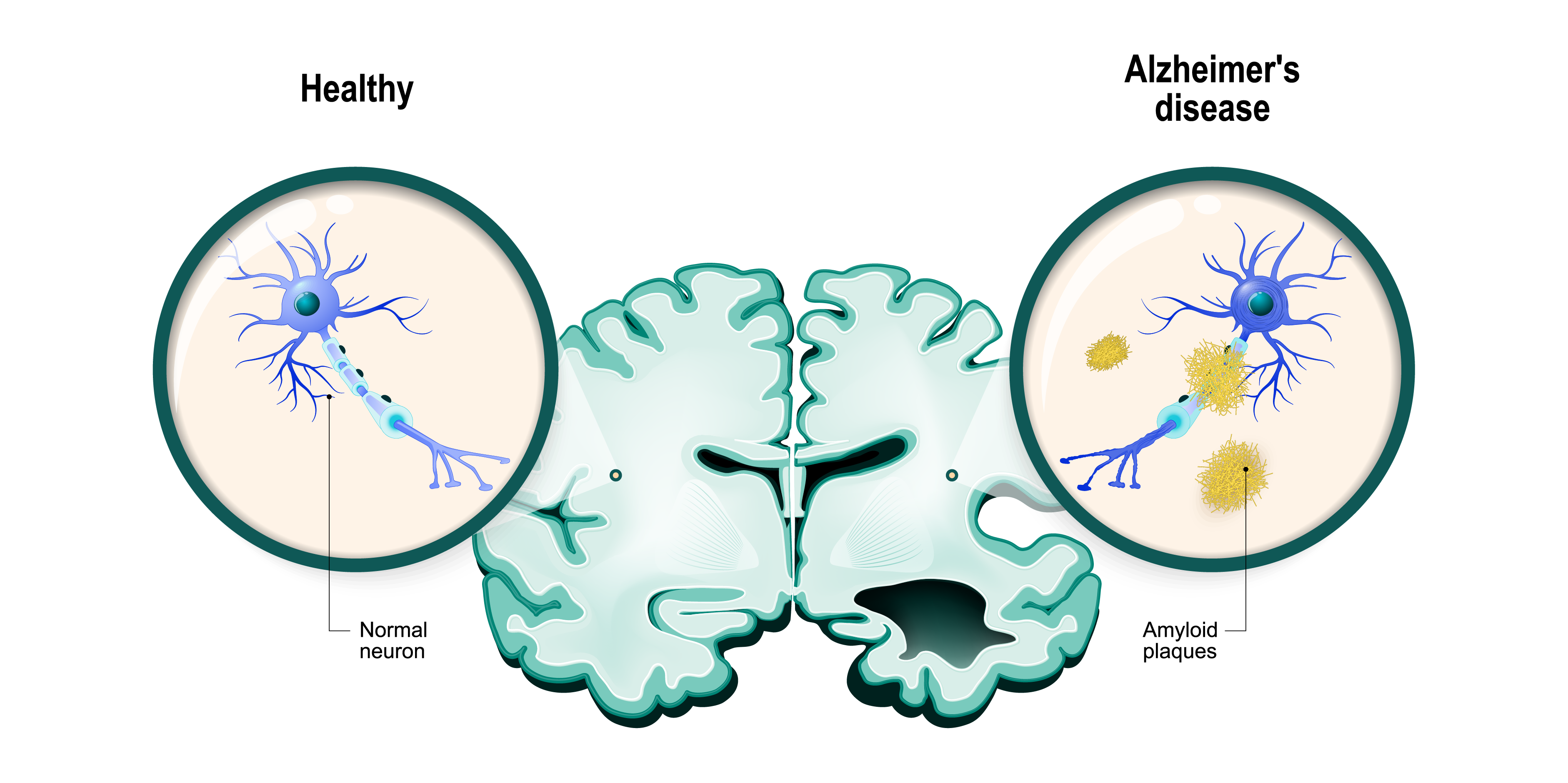 Alzheimer Pathophysiology