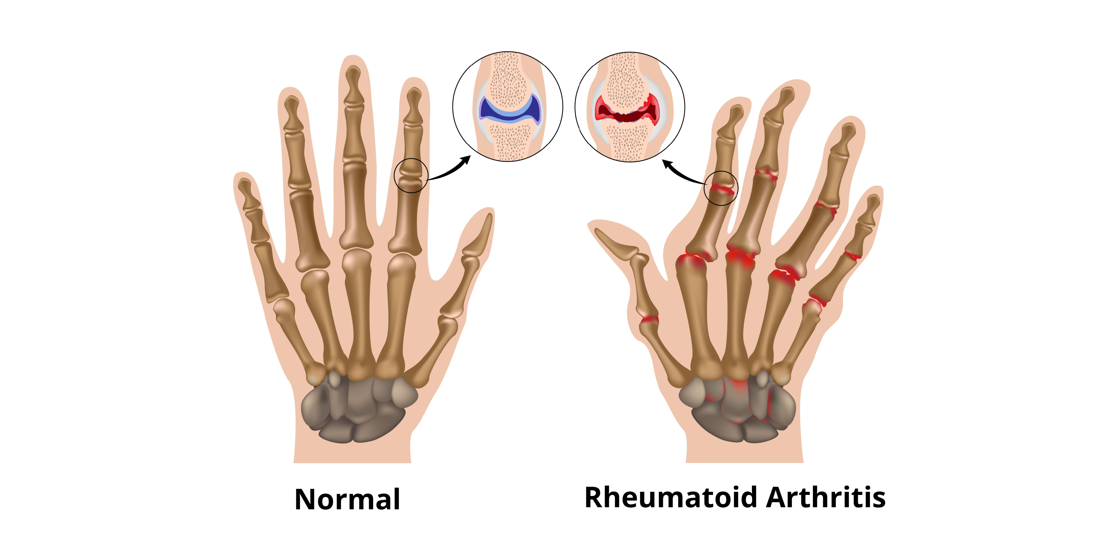 Rheumatoid Arthritis_Summary