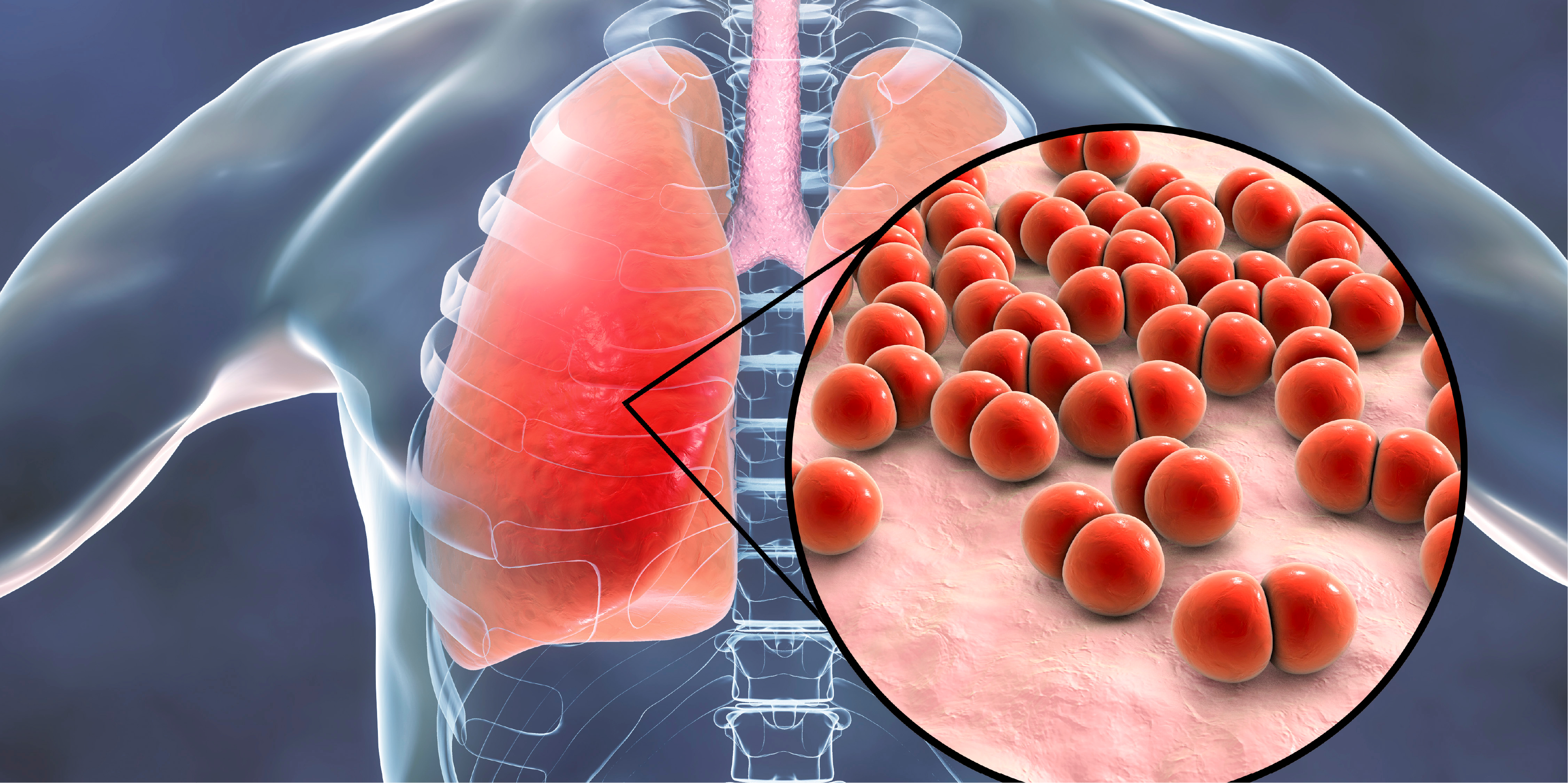 Pneumonia - Community-Acquired_Disease Background