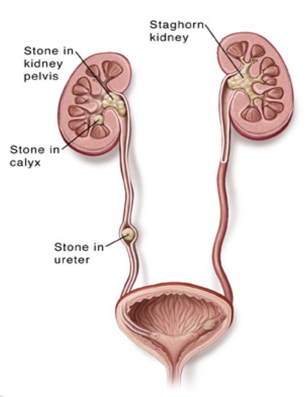 Kidney stones [Image courtesy of NUH]