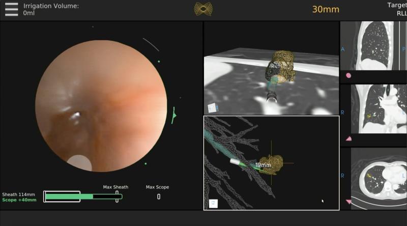 Preview of lesion location with real-time optical imaging and electromagnetic navigation