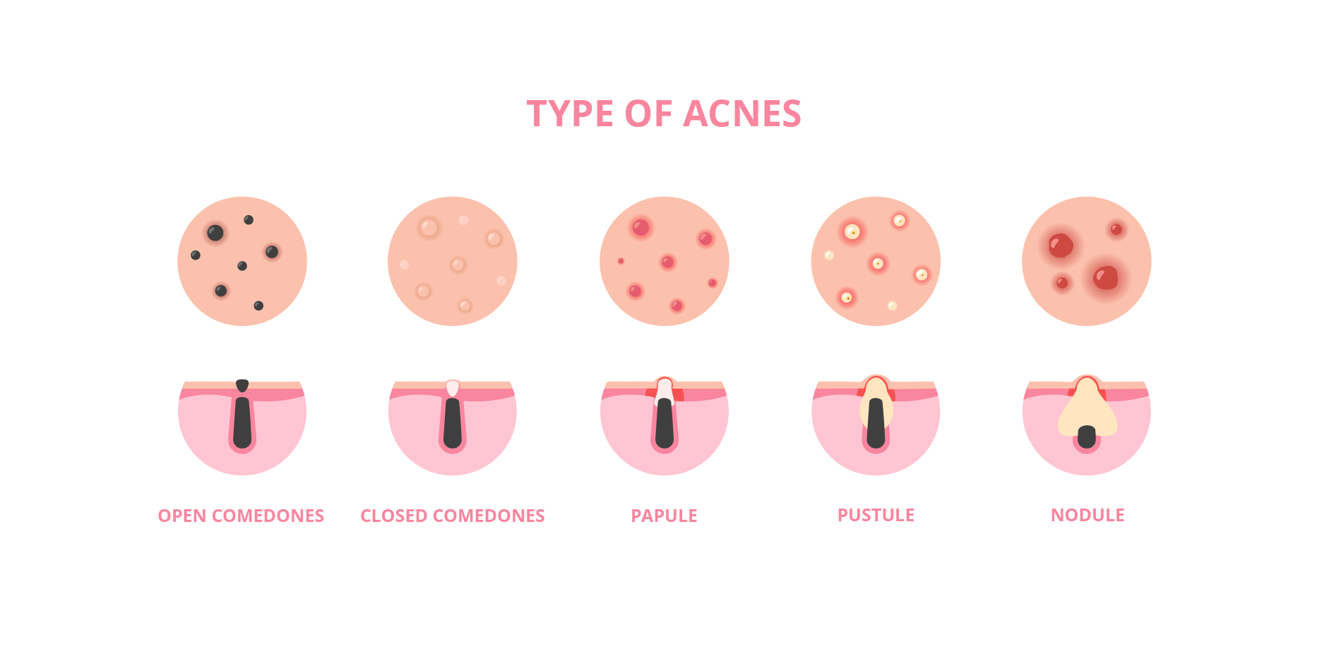Acne Vulgaris_Disease Background 3