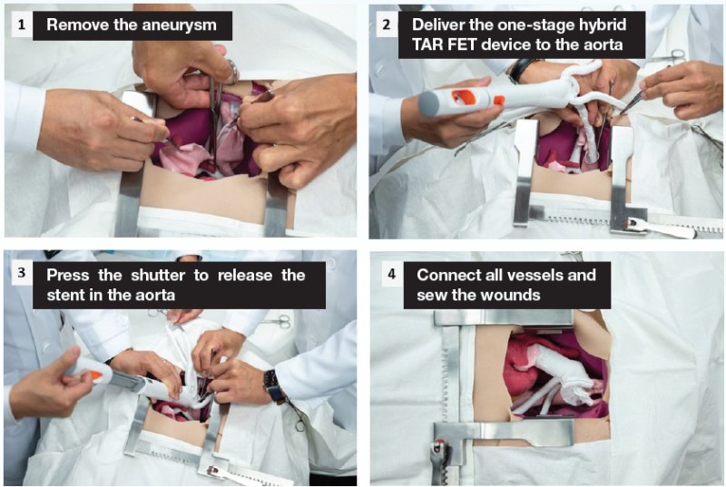 Mock procedure of one-stage hybrid aortic arch surgery for multisegment thoracic aortic diseases