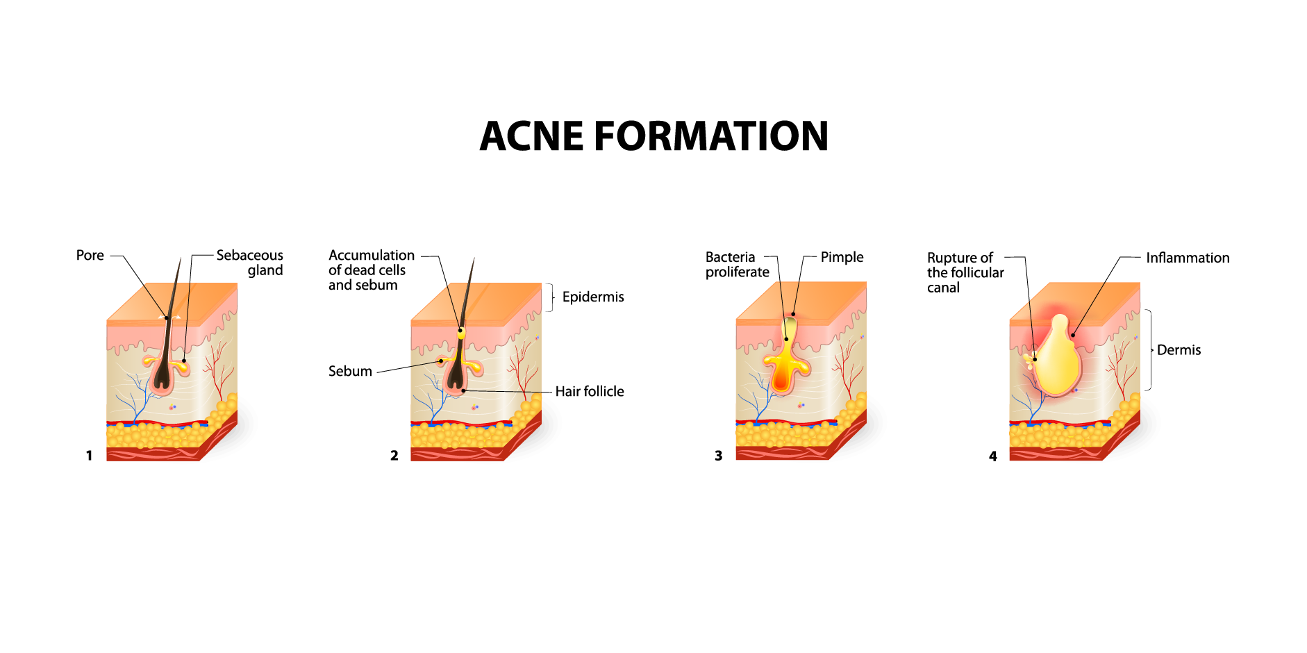 Acne Vulgaris_Disease Background 2