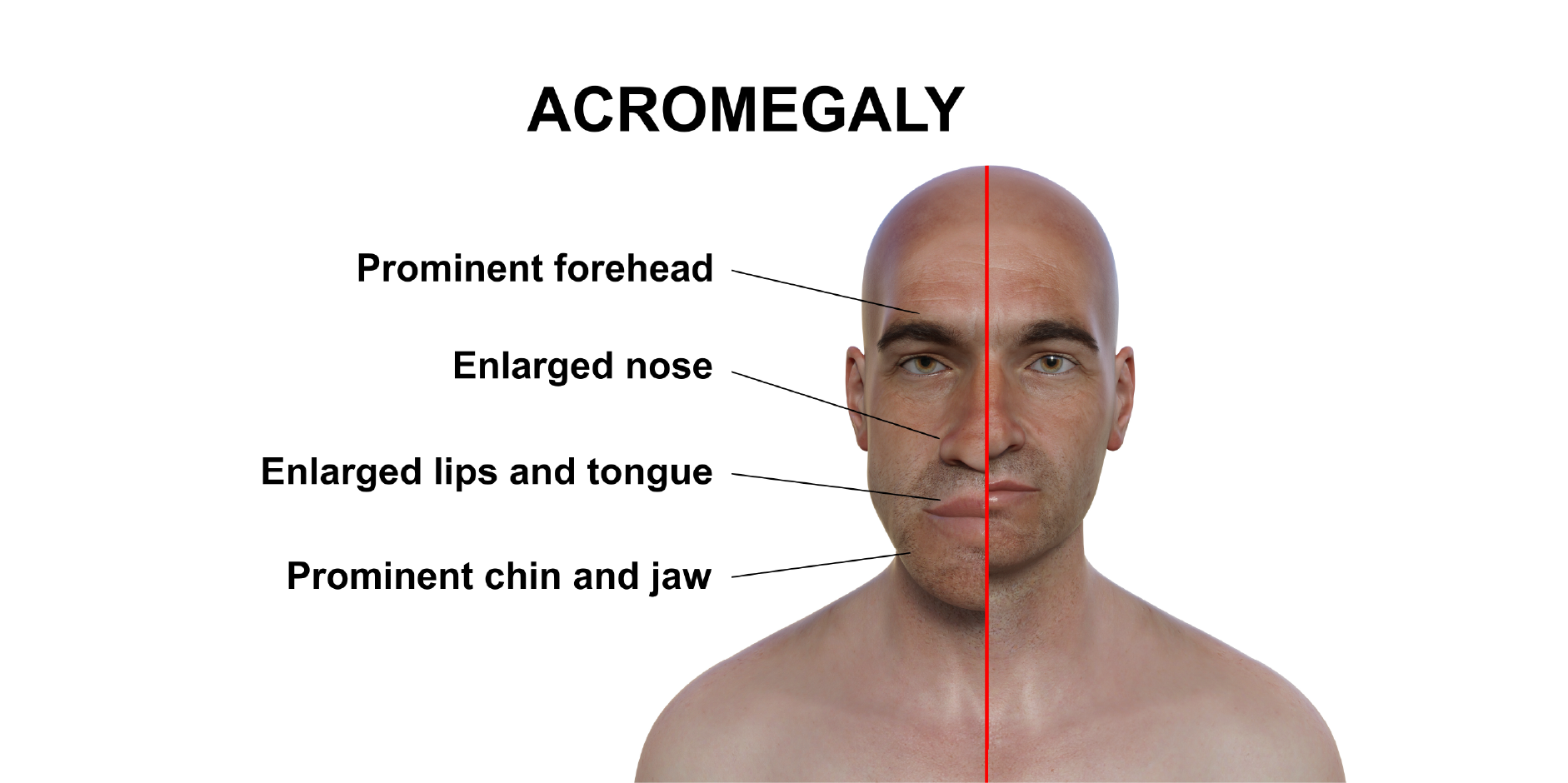 Acromegaly.ai_Initial Assesment