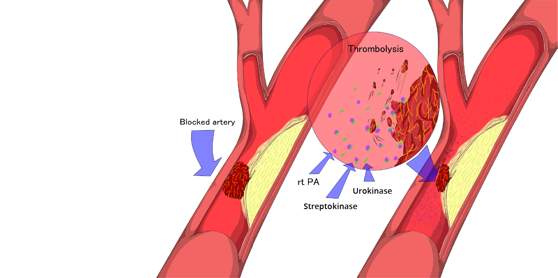Venous Thromboembolism - Management_Management 2