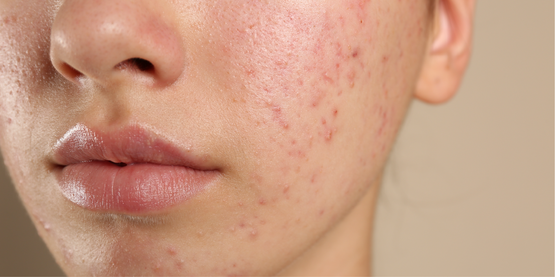 Acne Vulgaris_Disease Background 1