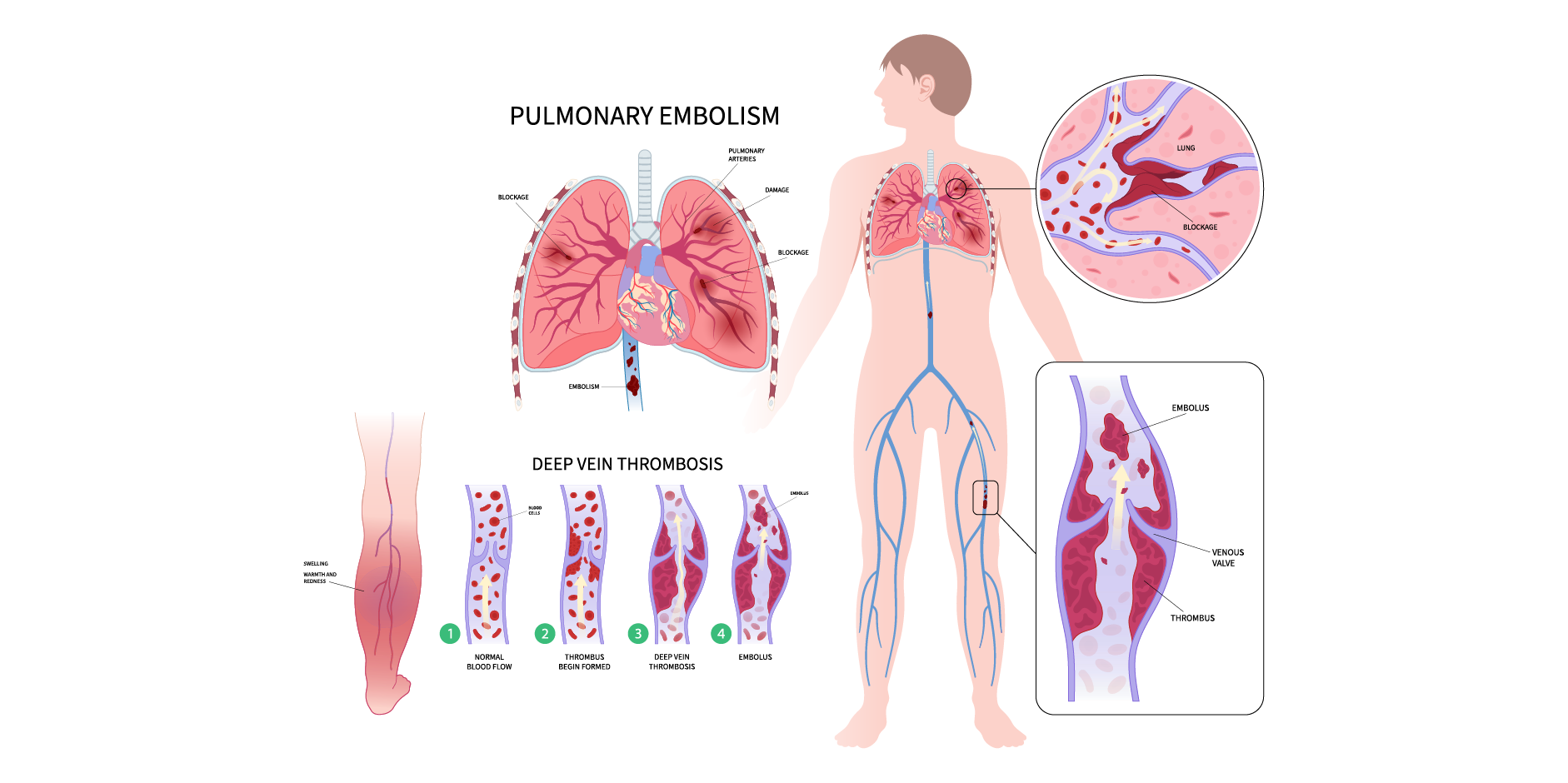 Venous Thromboembolism - Management_Disease Background