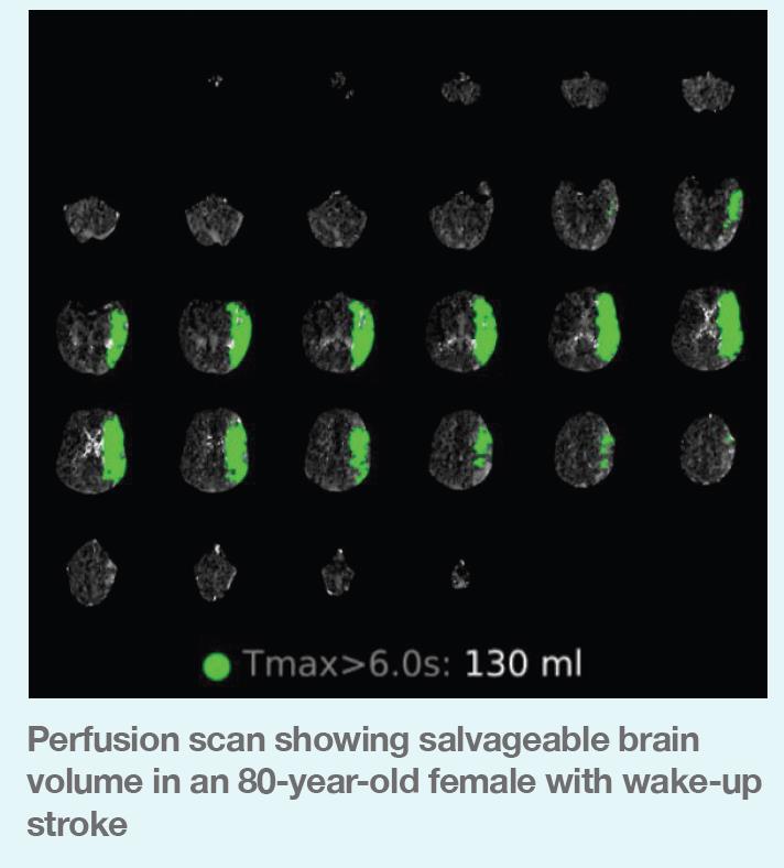 Perfusion scan showing salvageable brain volume in an 80-year-old female with wake-up stroke
