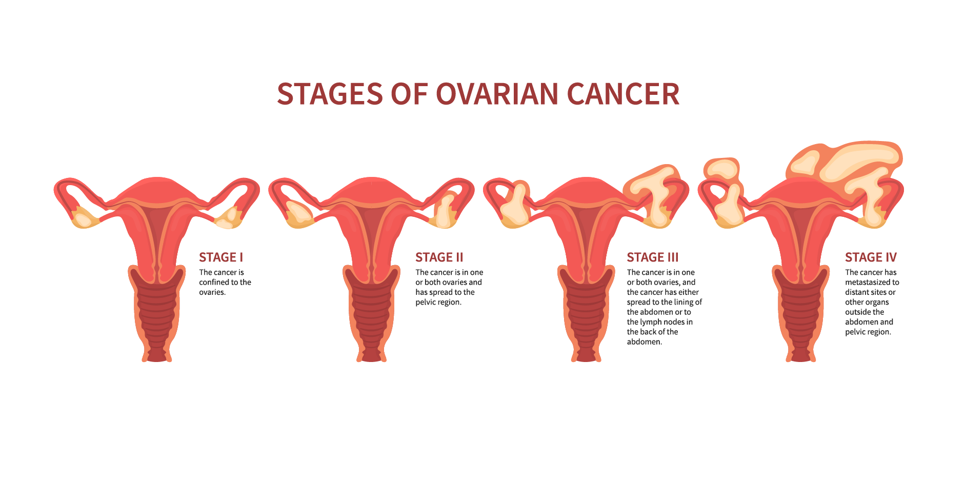Ovarian Cancer_Management