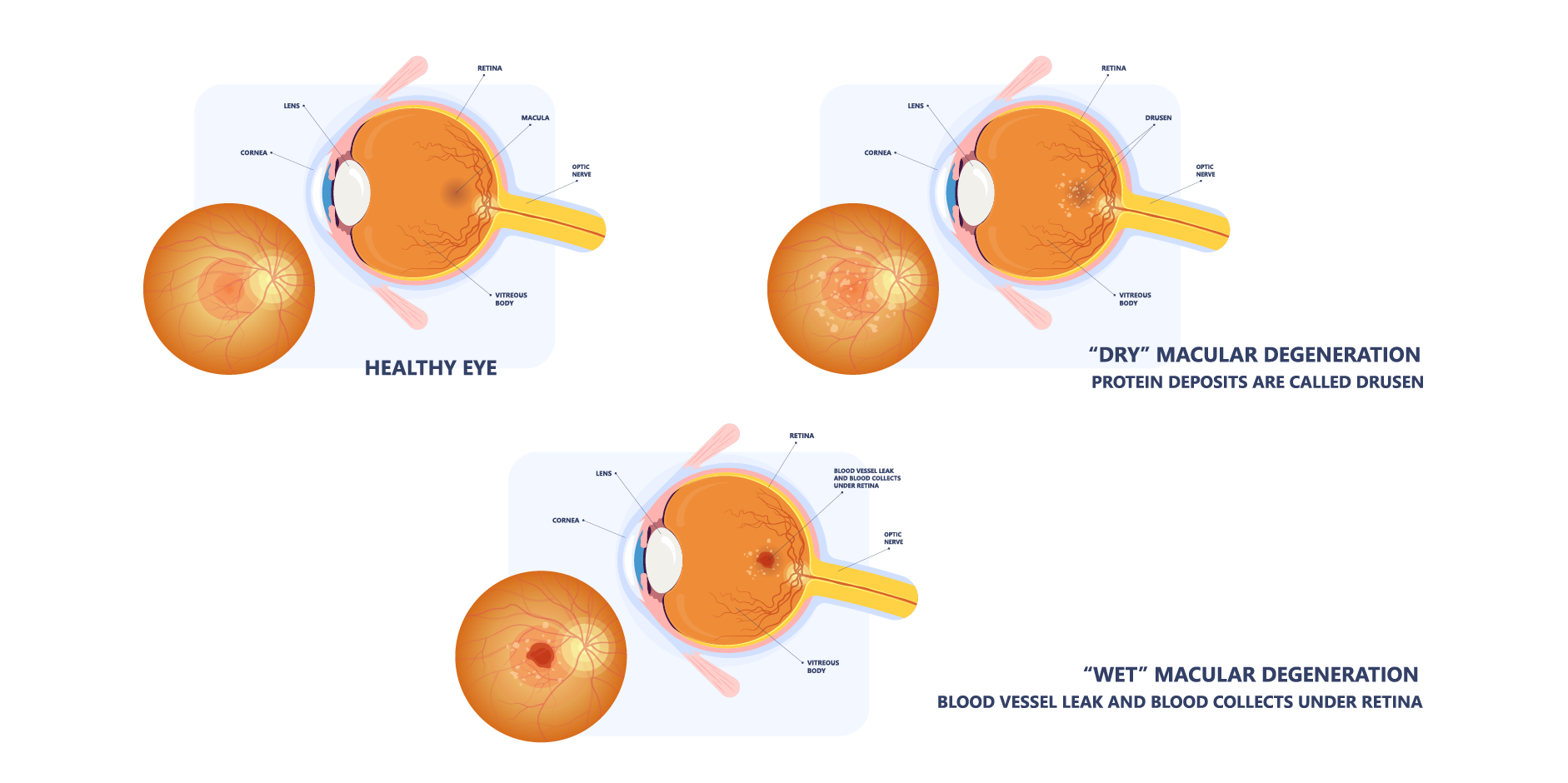 Age-Related Macular Degeneration_Initial Assesment 2