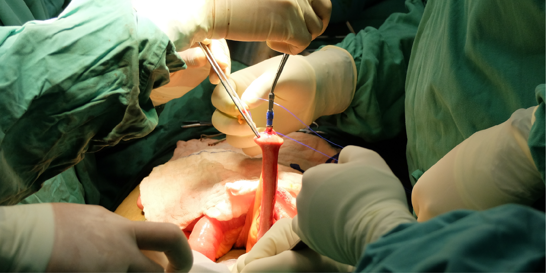 Colorectal Cancer_Management 4